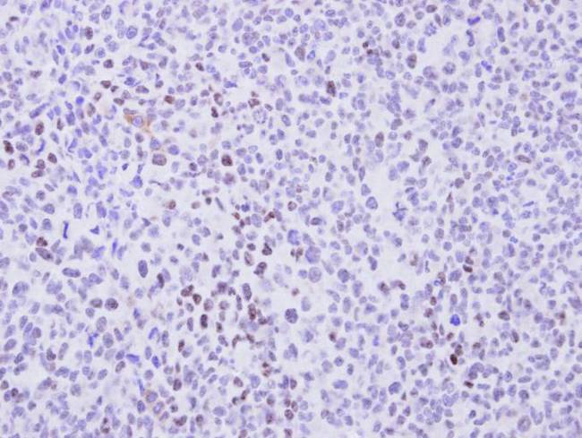 CCNT2 / Cyclin T2 Antibody - IHC of paraffin-embedded H1299 Xenograft using cyclin T2 antibody at 1:100 dilution.