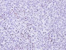 CCNT2 / Cyclin T2 Antibody - IHC of paraffin-embedded H1299 Xenograft using cyclin T2 antibody at 1:100 dilution.