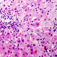CCP110 Antibody - Immunohistochemical analysis of CEP110 staining in human liver cancer formalin fixed paraffin embedded tissue section. The section was pre-treated using heat mediated antigen retrieval with sodium citrate buffer (pH 6.0). The section was then incubated with the antibody at room temperature and detected using an HRP conjugated compact polymer system. DAB was used as the chromogen. The section was then counterstained with hematoxylin and mounted with DPX. w