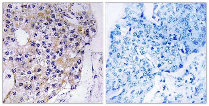 CCP110 Antibody - Peptide - + Immunohistochemistry analysis of paraffin-embedded human breast carcinoma tissue using CEP110 antibody.