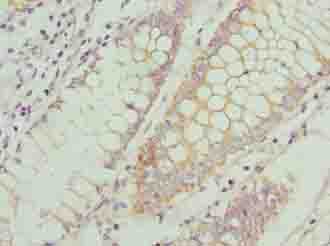CCR1 Antibody - Immunohistochemistry of paraffin-embedded human colon cancer using antibody at dilution of 1:100.