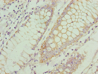CCR1 Antibody - Immunohistochemistry of paraffin-embedded human colon cancer using CCR1 Antibody at dilution of 1:100