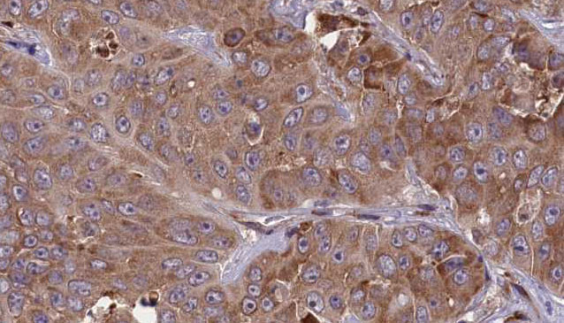 CCR1 Antibody - 1:100 staining human liver carcinoma tissues by IHC-P. The sample was formaldehyde fixed and a heat mediated antigen retrieval step in citrate buffer was performed. The sample was then blocked and incubated with the antibody for 1.5 hours at 22°C. An HRP conjugated goat anti-rabbit antibody was used as the secondary.