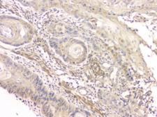CCR10 / GPR2 Antibody - IHC staining of FFPE human esophageal squamous cancer with CCR10 antibody at 1ug/ml. HIER: boil tissue sections in pH6, 10mM citrate buffer, for 10-20 min and allow to cool before testing.