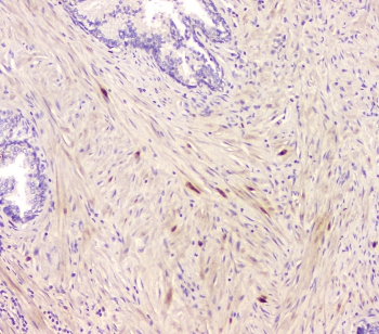 CCR10 / GPR2 Antibody - IHC staining of FFPE human prostate cancer with CCR10 antibody at 1ug/ml. HIER: boil tissue sections in pH6, 10mM citrate buffer, for 10-20 min and allow to cool before testing.