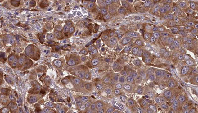 CCR2 Antibody - 1:100 staining human liver carcinoma tissues by IHC-P. The sample was formaldehyde fixed and a heat mediated antigen retrieval step in citrate buffer was performed. The sample was then blocked and incubated with the antibody for 1.5 hours at 22°C. An HRP conjugated goat anti-rabbit antibody was used as the secondary.