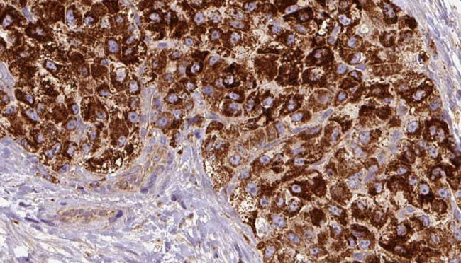 CCR3 Antibody - 1:100 staining human liver carcinoma tissues by IHC-P. The sample was formaldehyde fixed and a heat mediated antigen retrieval step in citrate buffer was performed. The sample was then blocked and incubated with the antibody for 1.5 hours at 22°C. An HRP conjugated goat anti-rabbit antibody was used as the secondary.