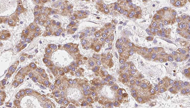 CCR4 Antibody - 1:100 staining human liver carcinoma tissues by IHC-P. The sample was formaldehyde fixed and a heat mediated antigen retrieval step in citrate buffer was performed. The sample was then blocked and incubated with the antibody for 1.5 hours at 22°C. An HRP conjugated goat anti-rabbit antibody was used as the secondary.