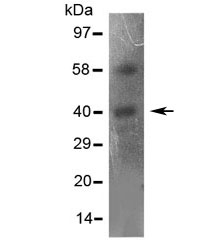 CCR5 Antibody - IHC-P: CCR5 antibody testing of human rectal cancer tissue