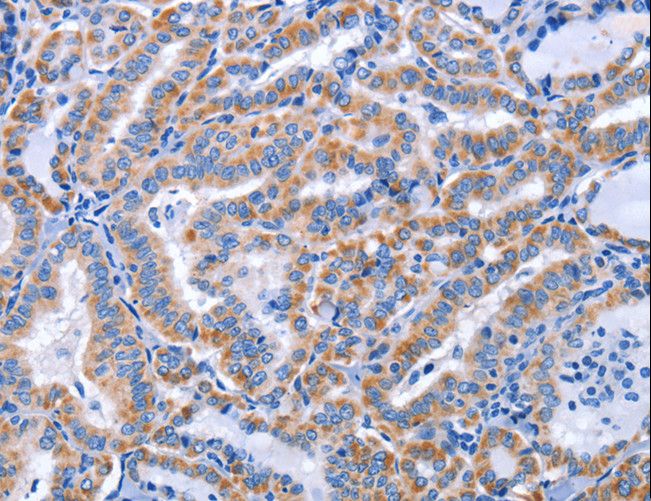 CCR6 Antibody - Immunohistochemistry of paraffin-embedded Human thyroid cancer using CCR6 Polyclonal Antibody at dilution of 1:50.