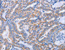CCR6 Antibody - Immunohistochemistry of paraffin-embedded Human thyroid cancer using CCR6 Polyclonal Antibody at dilution of 1:50.