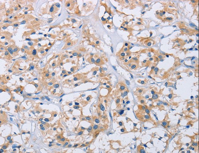 CCR9 / CD199 Antibody - Immunohistochemistry of paraffin-embedded Human thyroid cancer using CCR9 Polyclonal Antibody at dilution of 1:60.
