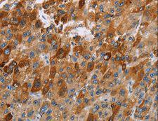 CCR9 / CD199 Antibody - Immunohistochemistry of paraffin-embedded Human thyroid cancer using CCR9 Polyclonal Antibody at dilution of 1:40.