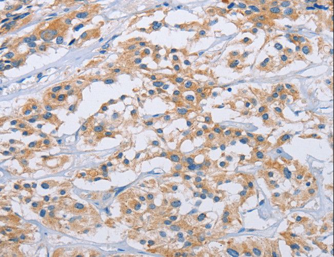 CCR9 / CD199 Antibody - Immunohistochemistry of paraffin-embedded Human thyroid cancer using CCR9 Polyclonal Antibody at dilution of 1:40.