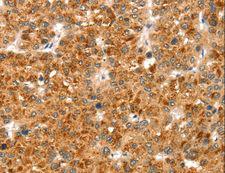 CCS Antibody - Immunohistochemistry of paraffin-embedded Human liver cancer using CCS Polyclonal Antibody at dilution of 1:35.