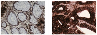 CCT2 / CCT Beta Antibody - Left and Center: IHC of normal (left) and cancerous (center) colon tissue using TCP-1 antibody (T-Complex Protein 1,   subunit). Right: Western blot of TCP-1 antibody on Calu6 (1) and HT-29 (2) cell lysates.