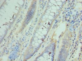 CCT3 Antibody - Immunohistochemistry of paraffin-embedded human colon cancer using antibody at 1:100 dilution.