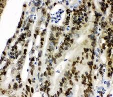 CCT3 Antibody - IHC analysis of CCT3 using anti-CCT3 antibody. CCT3 was detected in paraffin-embedded section of human intestinal cancer tissue. Heat mediated antigen retrieval was performed in citrate buffer (pH6, epitope retrieval solution) for 20 mins. The tissue section was blocked with 10% goat serum. The tissue section was then incubated with 1µg/ml rabbit anti-CCT3 Antibody overnight at 4°C. Biotinylated goat anti-rabbit IgG was used as secondary antibody and incubated for 30 minutes at 37°C. The tissue section was developed using Strepavidin-Biotin-Complex (SABC) with DAB as the chromogen.