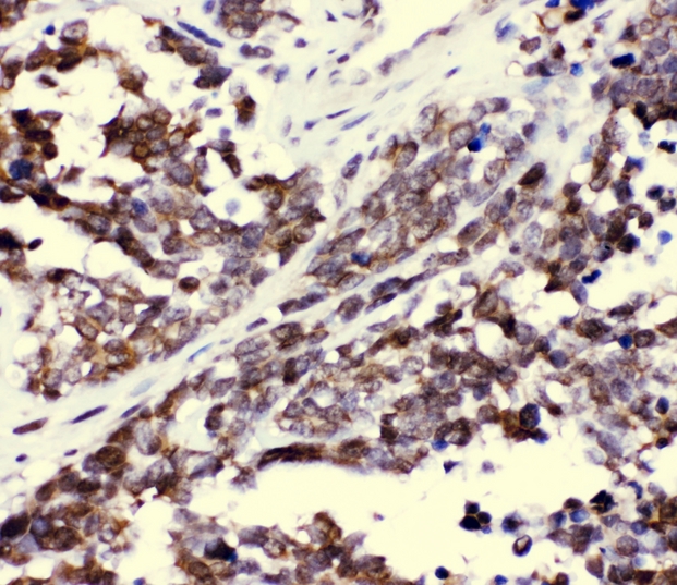 CCT3 Antibody - IHC analysis of CCT3 using anti-CCT3 antibody. CCT3 was detected in paraffin-embedded section of human lung cancer tissue. Heat mediated antigen retrieval was performed in citrate buffer (pH6, epitope retrieval solution) for 20 mins. The tissue section was blocked with 10% goat serum. The tissue section was then incubated with 1µg/ml rabbit anti-CCT3 Antibody overnight at 4°C. Biotinylated goat anti-rabbit IgG was used as secondary antibody and incubated for 30 minutes at 37°C. The tissue section was developed using Strepavidin-Biotin-Complex (SABC) with DAB as the chromogen.