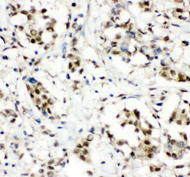 CCT3 Antibody - IHC analysis of CCT3 using anti-CCT3 antibody. CCT3 was detected in paraffin-embedded section of human mammary cancer tissue. Heat mediated antigen retrieval was performed in citrate buffer (pH6, epitope retrieval solution) for 20 mins. The tissue section was blocked with 10% goat serum. The tissue section was then incubated with 1µg/ml rabbit anti-CCT3 Antibody overnight at 4°C. Biotinylated goat anti-rabbit IgG was used as secondary antibody and incubated for 30 minutes at 37°C. The tissue section was developed using Strepavidin-Biotin-Complex (SABC) with DAB as the chromogen.