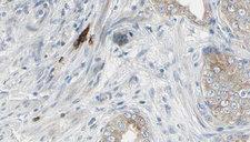 CCT3 Antibody - 1:100 staining human prostate tissue by IHC-P. The sample was formaldehyde fixed and a heat mediated antigen retrieval step in citrate buffer was performed. The sample was then blocked and incubated with the antibody for 1.5 hours at 22°C. An HRP conjugated goat anti-rabbit antibody was used as the secondary.