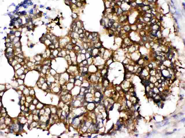 CCT5 / TCP1 Epsilon Antibody - TCP1 epsilon was detected in paraffin-embedded sections of human intestinal cancer tissues using rabbit anti- TCP1 epsilon Antigen Affinity purified polyclonal antibody