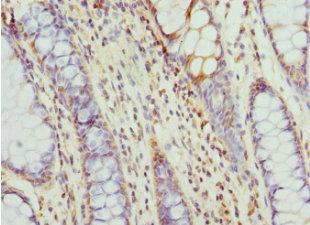 CCT5 / TCP1 Epsilon Antibody - Immunohistochemistry of paraffin-embedded human colon cancer tissue at dilution 1:100