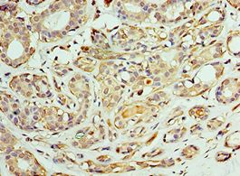 CCT6A Antibody - Immunohistochemistry of paraffin-embedded human breast cancer using antibody at 1:100 dilution.