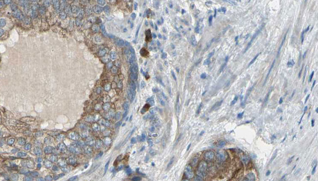 CCT6A Antibody - 1:100 staining human prostate tissue by IHC-P. The sample was formaldehyde fixed and a heat mediated antigen retrieval step in citrate buffer was performed. The sample was then blocked and incubated with the antibody for 1.5 hours at 22°C. An HRP conjugated goat anti-rabbit antibody was used as the secondary.