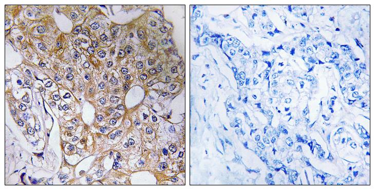 CCT6A Antibody - Peptide - + Immunohistochemistry analysis of paraffin-embedded human breast carcinoma tissue, using CCT6A antibody.