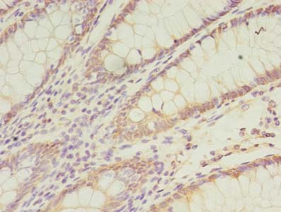 CCT6B Antibody - Immunohistochemistry of paraffin-embedded human colon cancer using antibody at dilution of 1:100.