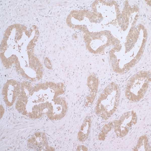 CCT7 Antibody - Detection of human CCT7 by immunohistochemistry. Sample: FFPE section of human prostate carcinoma. Antibody: Affinity purified rabbit anti- CCT7 used at a dilution of 1:5,000 (0.2µg/ml). Detection: DAB. Counterstain: IHC Hematoxylin (blue).