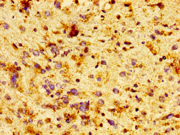 CCT7 Antibody - Immunohistochemistry image at a dilution of 1:100 and staining in paraffin-embedded human glioma cancer performed on a Leica BondTM system. After dewaxing and hydration, antigen retrieval was mediated by high pressure in a citrate buffer (pH 6.0) . Section was blocked with 10% normal goat serum 30min at RT. Then primary antibody (1% BSA) was incubated at 4 °C overnight. The primary is detected by a biotinylated secondary antibody and visualized using an HRP conjugated SP system.