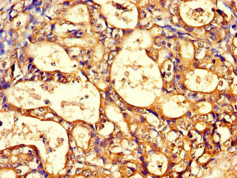 CCT8 Antibody - Immunohistochemistry of paraffin-embedded human gastric cancer using CCT8 Antibody at dilution of 1:100