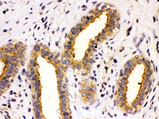 CCT8 Antibody - IHC testing of FFPE human breast cancer tissue with TCP1 theta antibody at 1ug/ml. HIER: steam in pH6 citrate buffer and allow to cool prior to staining.