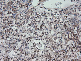 CCT8L2 Antibody - IHC of paraffin-embedded Carcinoma of Human kidney tissue using anti-CCT8L2 mouse monoclonal antibody. (Heat-induced epitope retrieval by 10mM citric buffer, pH6.0, 120°C for 3min).
