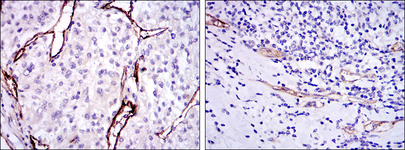 CD105 Antibody - IHC of paraffin-embedded kidney cancer tissues (left) and stomach cancer tissues (right) using CD105 mouse monoclonal antibody with DAB staining.