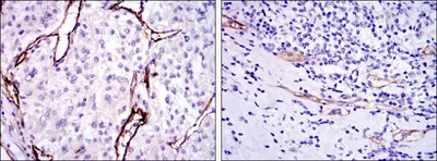 CD105 Antibody - Immunohistochemistry-Paraffin: CD105 Antibody (3A9) - Immunohistochemical analysis of paraffin-embedded kidney cancer tissues (left) and stomach cancer tissues (right) using CD105 mouse mAb with DAB staining.