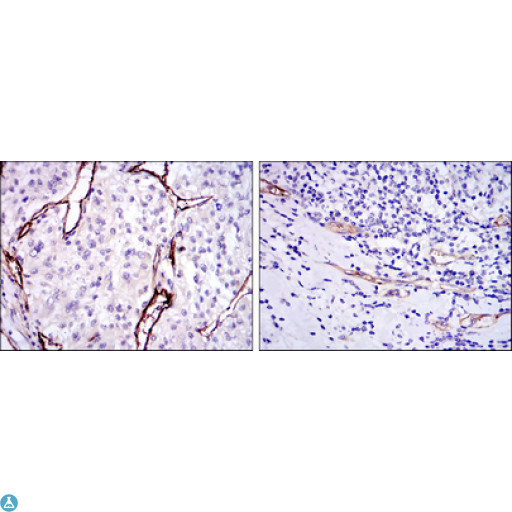 CD105 Antibody - Immunohistochemistry (IHC) analysis of paraffin-embedded kidney cancer tissues (left) and stomach cancer tissues (right) with DAB staining using CD105 Monoclonal Antibody.