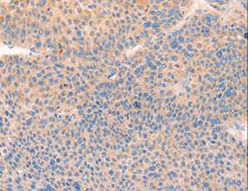 CD109 Antibody - Immunohistochemistry of paraffin-embedded Human thyroid cancer using CD109 Polyclonal Antibody at dilution of 1:30.
