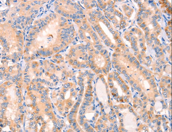 CD109 Antibody - Immunohistochemistry of paraffin-embedded Human thyroid cancer using CD109 Polyclonal Antibody at dilution of 1:30.