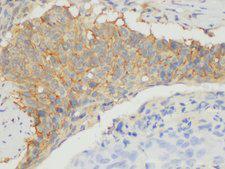 CD109 Antibody - Immunohistochemistry of paraffin-embedded Human lung cancer using CD109 Ployclonal Antibody at dilution of 1:100.