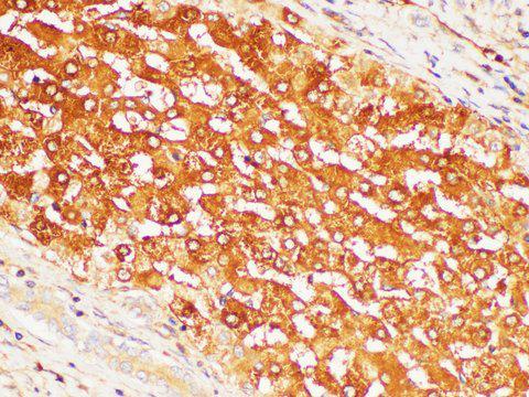 CD109 Antibody - Immunohistochemistry of paraffin-embedded Human liver cancer using CD109 Polycloanl Antibody at dilution of 1:200.