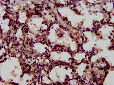 CD118 / LIF Receptor Alpha Antibody - Immunohistochemistry image at a dilution of 1:600 and staining in paraffin-embedded human lung tissue performed on a Leica BondTM system. After dewaxing and hydration, antigen retrieval was mediated by high pressure in a citrate buffer (pH 6.0) . Section was blocked with 10% normal goat serum 30min at RT. Then primary antibody (1% BSA) was incubated at 4 °C overnight. The primary is detected by a biotinylated secondary antibody and visualized using an HRP conjugated SP system.
