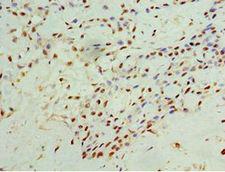 CD119 / IFNGR1 Antibody - Immunohistochemistry of paraffin-embedded human breast cancer using antibody at 1:100 dilution.