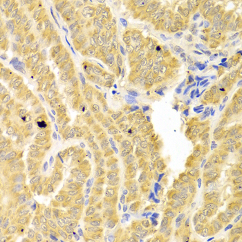 CD121b / IL1R2 Antibody - Immunohistochemistry of paraffin-embedded human thyroid cancer tissue.