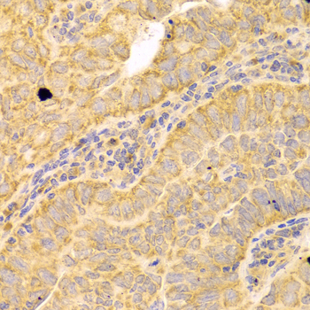 CD121b / IL1R2 Antibody - Immunohistochemistry of paraffin-embedded human endometrial cancer tissue.