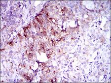 CD135 / FLT3 Antibody - IHC of paraffin-embedded cervical cancer tissues using FLT3 mouse monoclonal antibody with DAB staining.