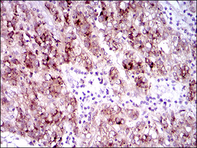 CD135 / FLT3 Antibody - IHC of paraffin-embedded liver cancer tissues using FLT3 mouse monoclonal antibody with DAB staining.
