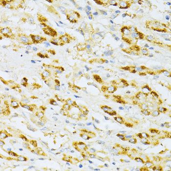 CD135 / FLT3 Antibody - Immunohistochemistry of paraffin-embedded human liver cancer using FLT3 antibody at dilution of 1:100 (40x lens).